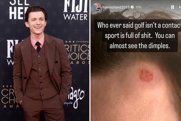 actor-tom-holland-shares-photo-of-huge-welt-on-his-forehead-from-golf-course-mishap